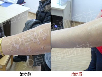 遗传性牛皮癣患者在郑州市银屑病康复